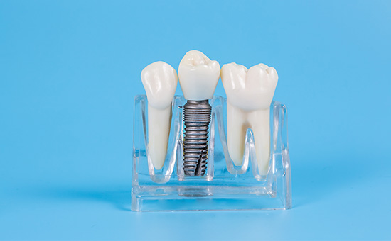 合肥看种植牙的医院那个好_什么是快速种植牙(图1)