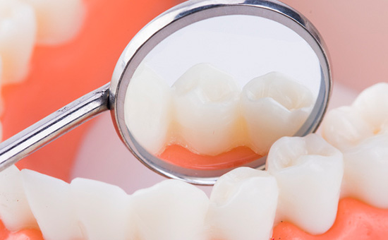 合肥看种植牙比较厉害的医院-为什么建议镶牙不要种牙(图1)