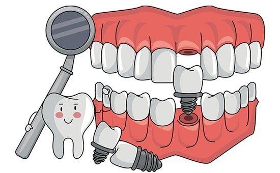 合肥看种植牙好的医院在哪里_做完种植牙手术后能吃什么(图1)